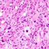 1B3 Pleomorphic Xanthoastrocytoma (Case 1) H&E 3