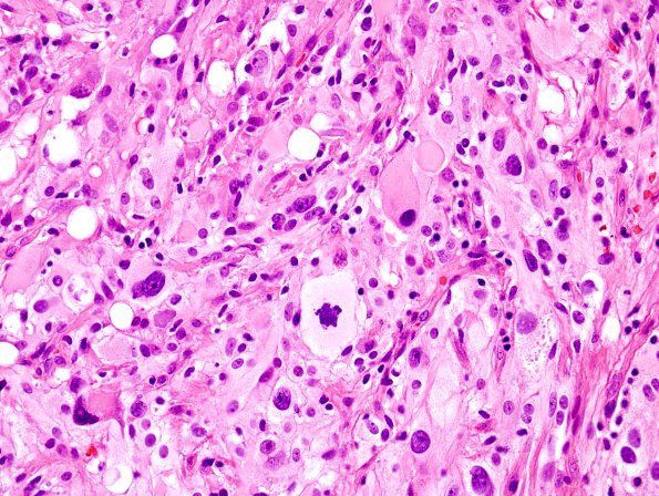 1B3 Pleomorphic Xanthoastrocytoma (Case 1) H&E 3