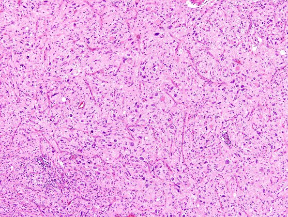 1B4 Pleomorphic Xanthoastrocytoma (Case 1) H&E 12