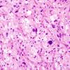 1B5 Pleomorphic Xanthoastrocytoma (Case 1) H&E 5