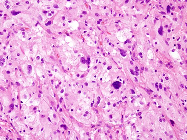 1B5 Pleomorphic Xanthoastrocytoma (Case 1) H&E 5