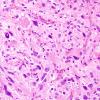 1B6 Pleomorphic Xanthoastrocytoma (Case 1) H&E 10