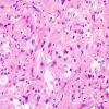 1B7 Pleomorphic Xanthoastrocytoma (Case 1) H&E 19