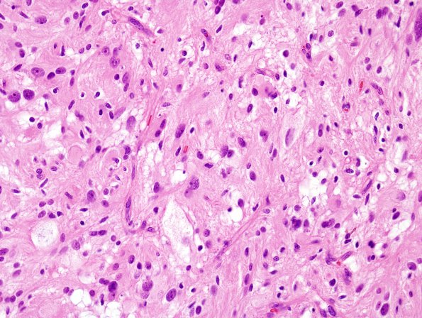 1B7 Pleomorphic Xanthoastrocytoma (Case 1) H&E 19