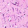 1B8 Pleomorphic Xanthoastrocytoma (Case 1) H&E 13