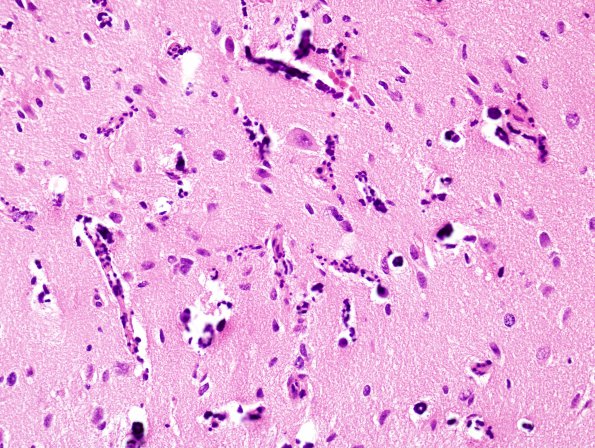 1B8 Pleomorphic Xanthoastrocytoma (Case 1) H&E 13