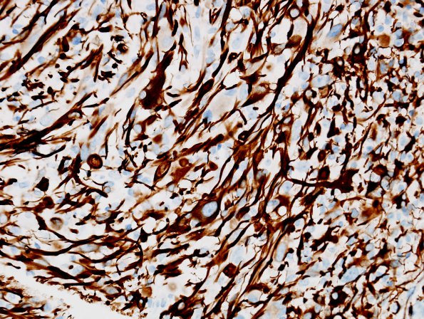 1C1 Pleomorphic Xanthoastrocytoma (Case 1) GFAP 3