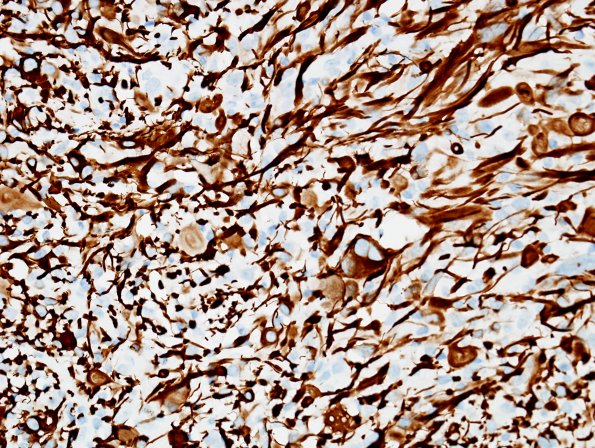 1C2 Pleomorphic Xanthoastrocytoma (Case 1) GFAP 8