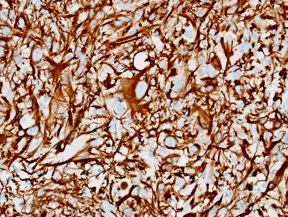 1C3 Pleomorphic Xanthoastrocytoma (Case 1) GFAP 10