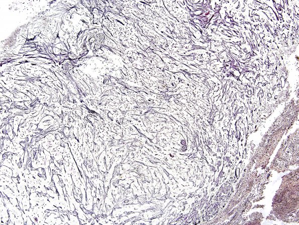 1D1 Pleomorphic Xanthoastrocytoma (Case 1) Retic 1