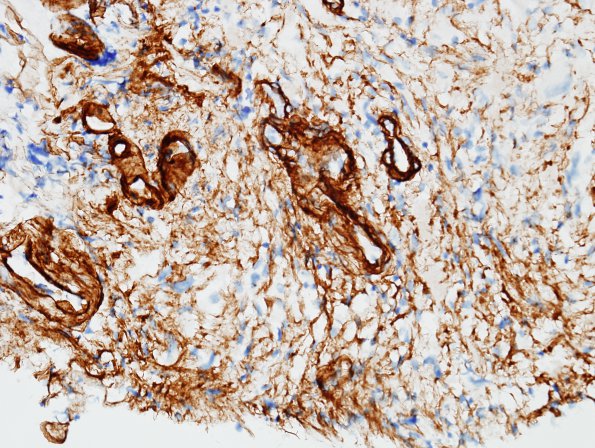 1D4 Pleomorphic Xanthoastrocytoma (Case 1) Coll IV 4