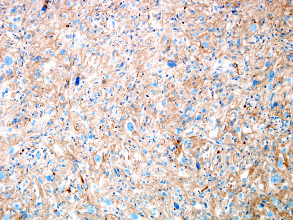 1E1 Pleomorphic Xanthoastrocytoma (Case 1) SYN 2