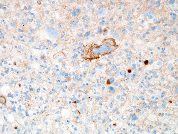 1E2 Pleomorphic Xanthoastrocytoma (Case 1) SYN 5