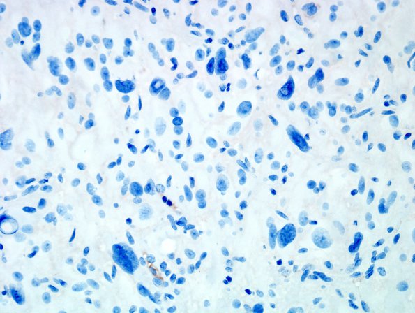 1F Pleomorphic Xanthoastrocytoma (Case 1) NF 1