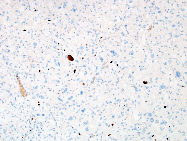 1H Pleomorphic Xanthoastrocytoma (Case 1) Ki67