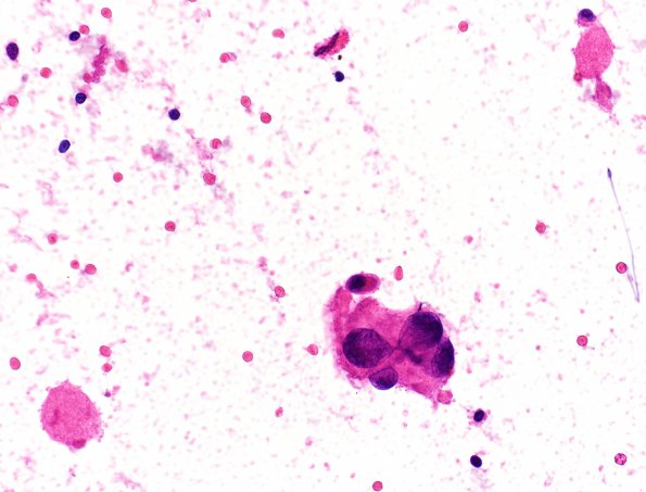 20A1 PXA (Case 20) A H&E Smear 40X 2