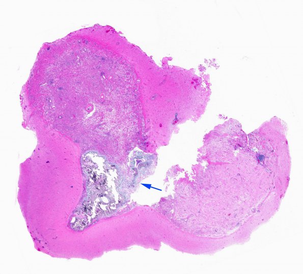 20A2 PXA (Case 20) H&E WM copy