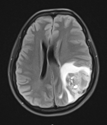 22A1 PXA (Case 22) FLAIR - Copy