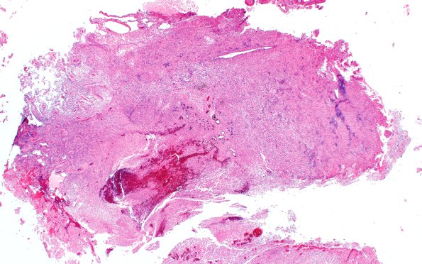 22B1 PXA (Case 22) H&E 2X