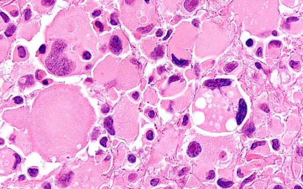 22B10 PXA (Case 22) H&E B2 100X 1