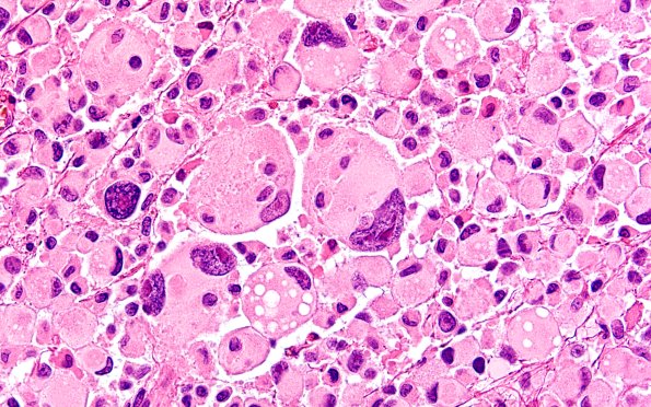 22B11 PXA (Case 22) H&E B2 60X 8