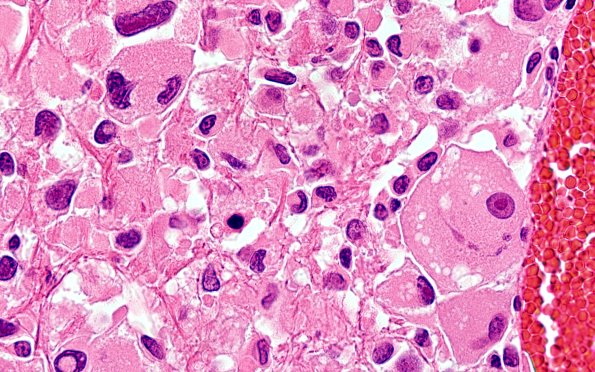 22B12 PXA (Case 22) H&E B2 100X 17