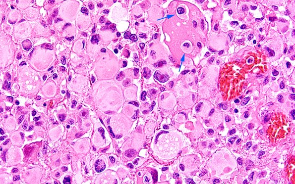 22B13 PXA (Case 22) H&E B2 60X 1 copy