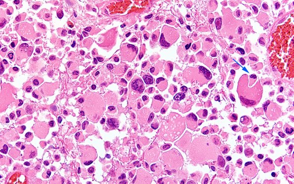 22B14 PXA (Case 22) H&E B2 60X 6 copy