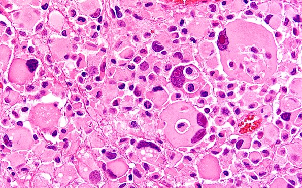 22B16 PXA (Case 22) H&E B2 60X 13