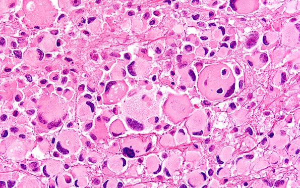 22B17 PXA (Case 22) H&E B2 60X 12