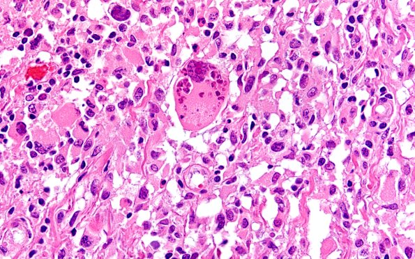 22B18 PXA (Case 22) H&E 60X 5