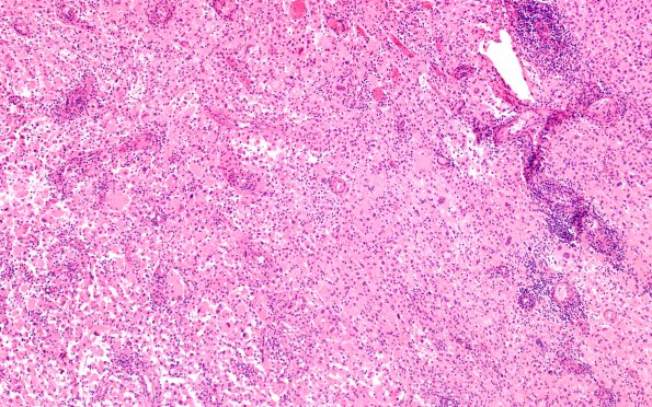 22B3A PXA (Case 22) H&E 10X