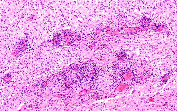 22B3B PXA (Case 22) H&E 20X 3