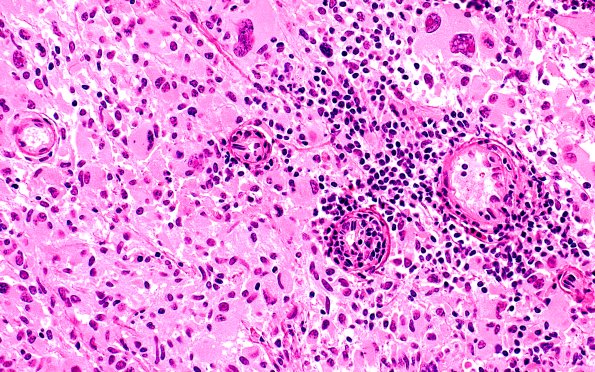 22B3C PXA (Case 22) H&E 40X 3