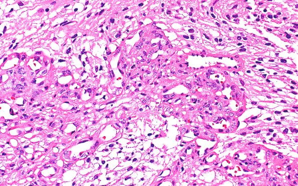 22B4 PXA (Case 22) H&E 40X 2