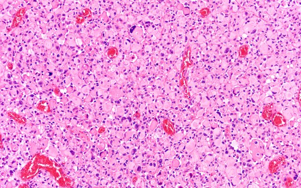 22B5 PXA (Case 22) H&E B2 20X 3