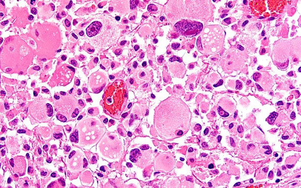 22B9 PXA (Case 22) H&E B2 60X 9