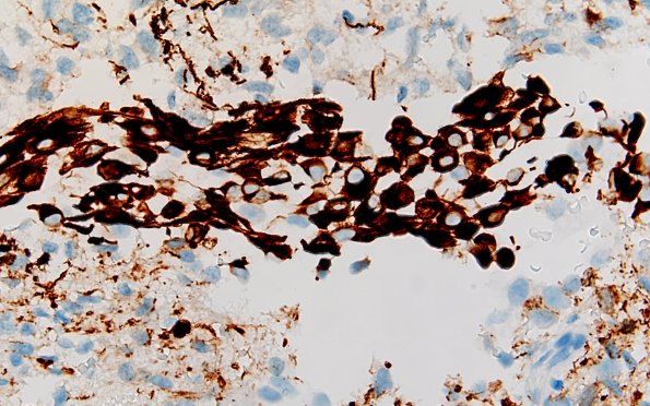 22C1 PXA (Case 22) GFAP A2 60X 2