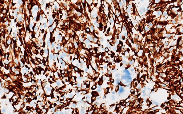 22C3 PXA (Case 22) H&E B2 40X 2