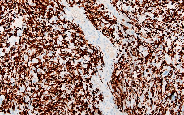 22C4 PXA (Case 22) GFAP A2 20X