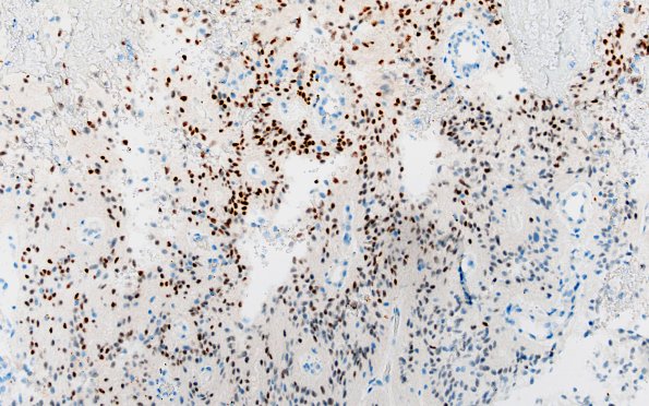 22D PXA (Case 22) B1 Olig2 20X