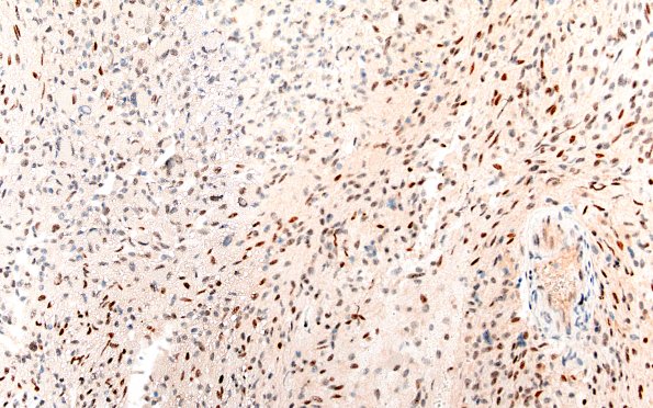 22E PXA (Case 22) B1 ATRX 20X