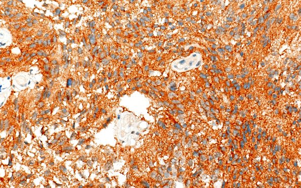 22F1 PXA (Case 22) SYN B1 40X 2