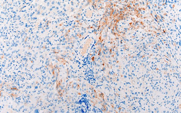 22F2 PXA (Case 22) SYN B1 20X 2