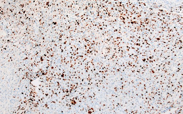 22G1 PXA (Case 22) B1 Ki67 10X