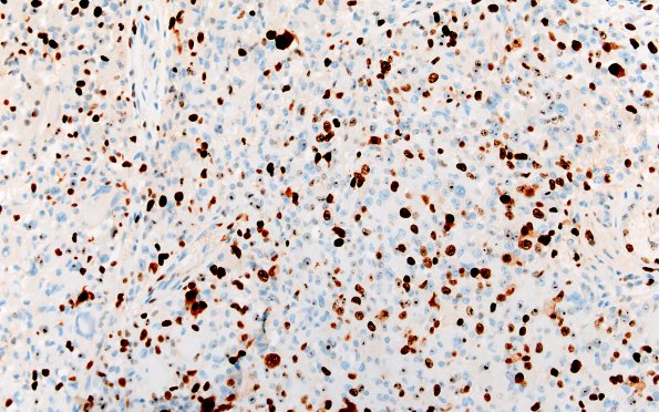 22G2 PXA (Case 22) B1 Ki67 20X