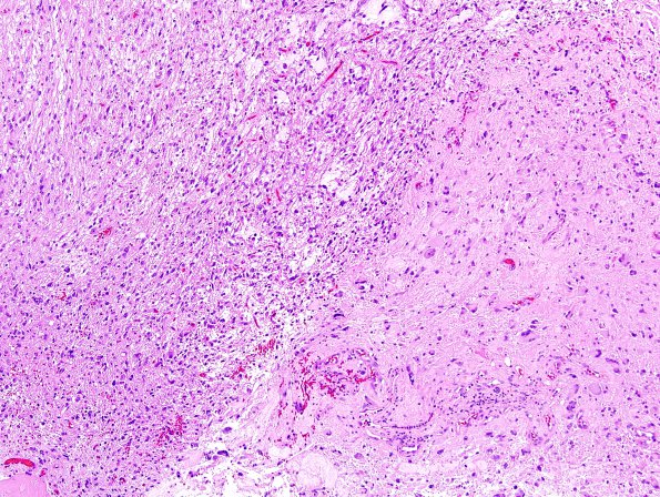 2A1 Pleomorphic Xanthoastrocytoma (Case 2) H&E 17