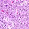 2A2 Pleomorphic Xanthoastrocytoma (Case 2) H&E 3