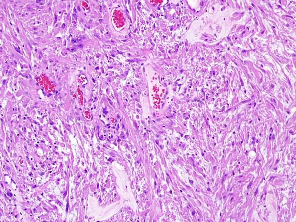 2A2 Pleomorphic Xanthoastrocytoma (Case 2) H&E 3