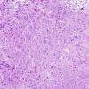 2A3 Pleomorphic Xanthoastrocytoma (Case 2) H&E 18